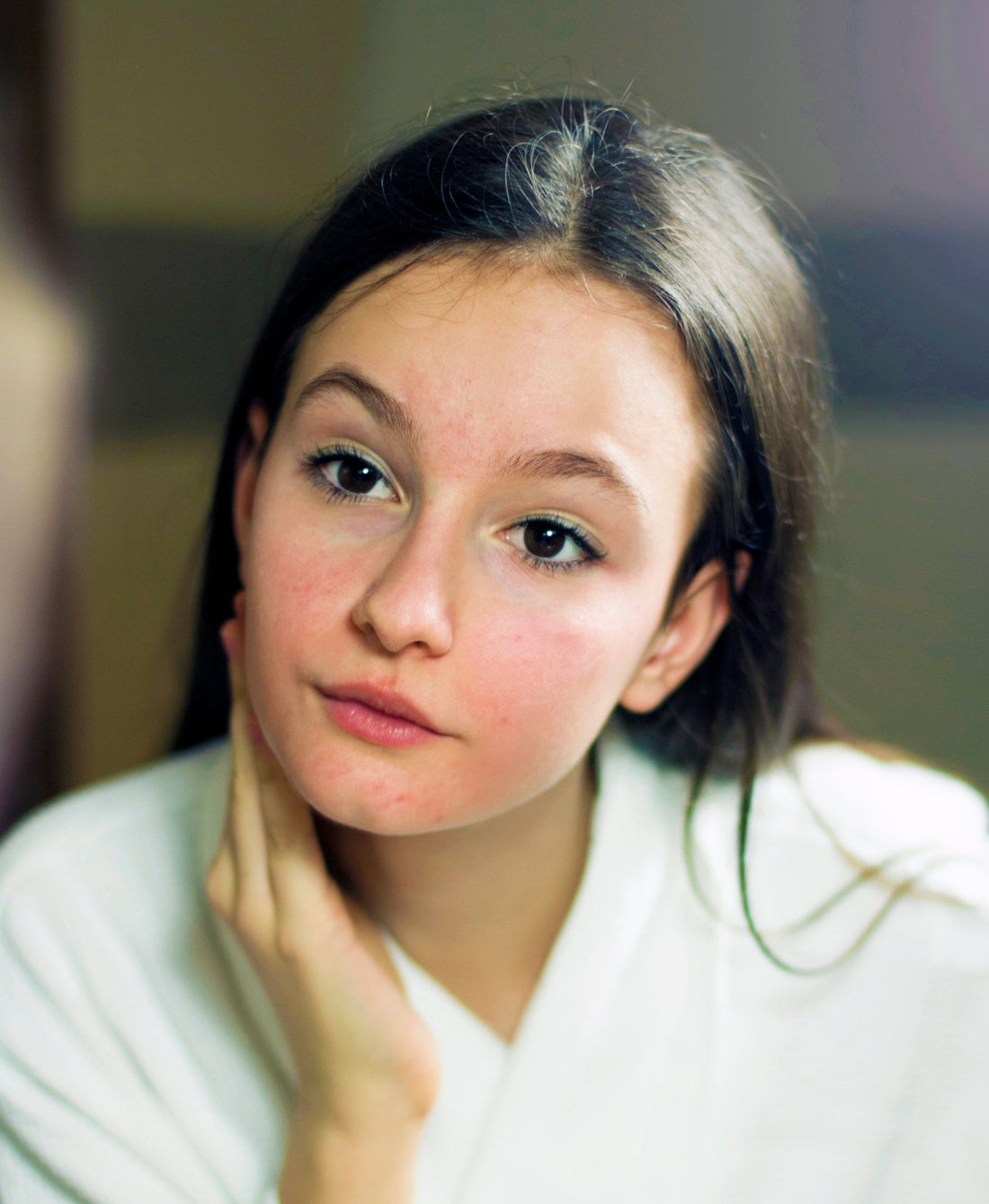 Is Rosacea Affecting Your Kid’s Skin Health? - Kidskin