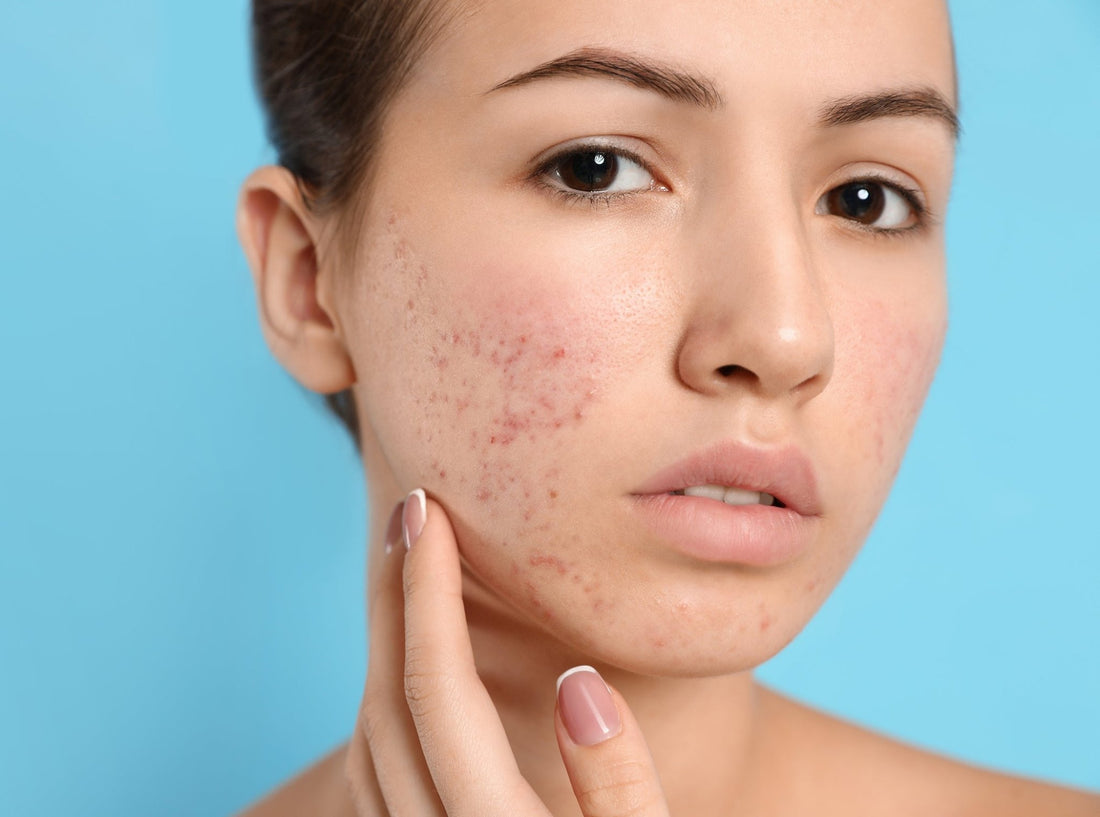 The Psychological Impact of Acne on Teens: How to Cope - Kidskin