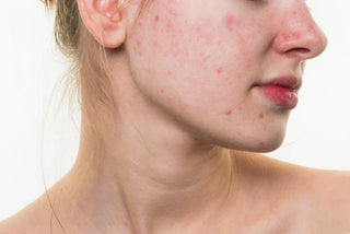 Understanding Teen Acne: Causes and Solutions