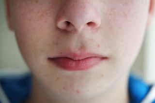Understanding Types of Acne - Kidskin