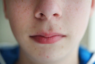 Understanding Types of Acne