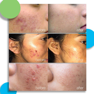 Kidskin 3-Step Acne Kit - Kidskin